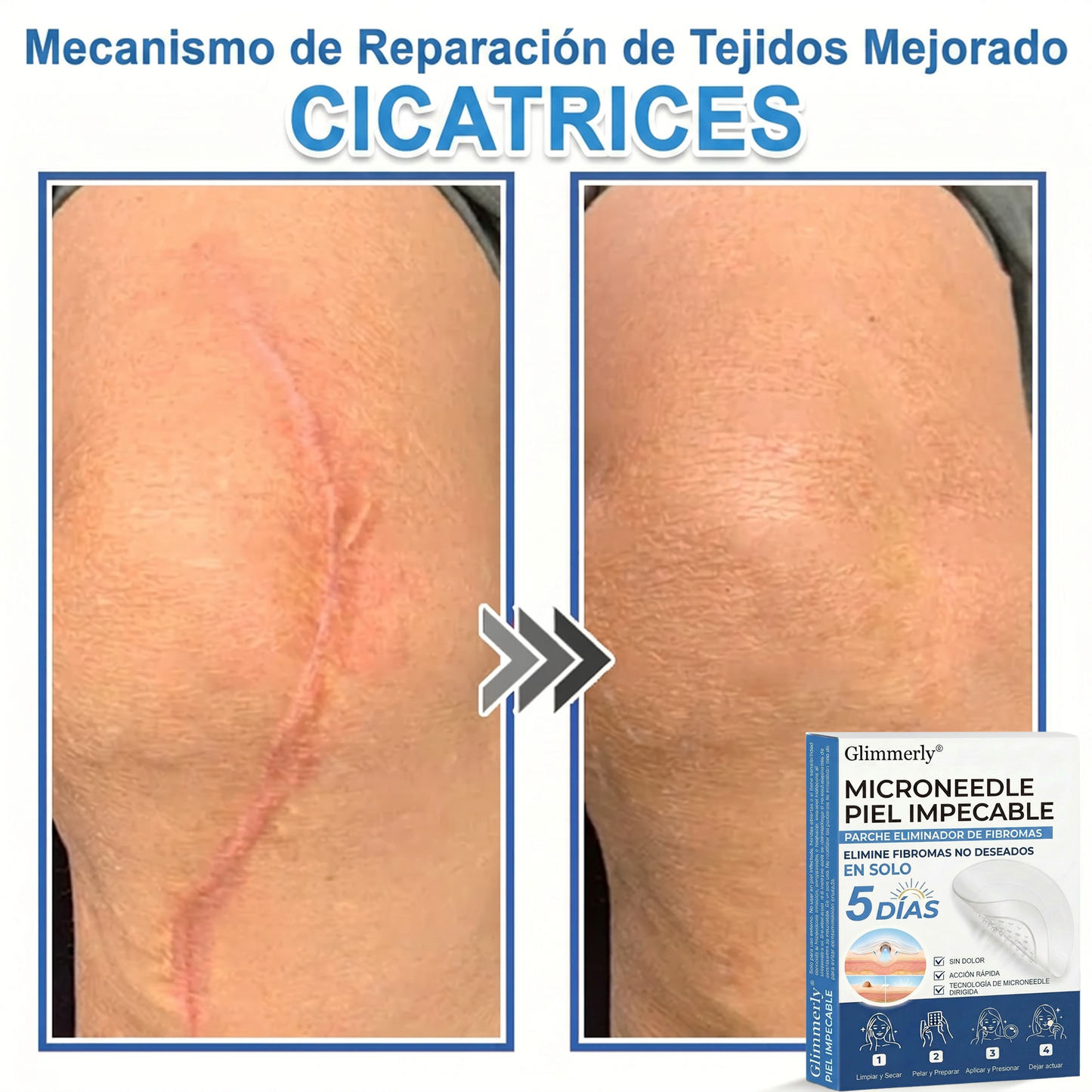 👩⚕️ Glimmerly® Parche 2 en 1 de microagujas e hidrocoloide | Eliminador de lunares en relieve, acné, verrugas planas y acrocordones | Mejora arrugas, cicatrices e imperfecciones | Parches invisibles para granos (rostro y cuerpo) | 144 unidades