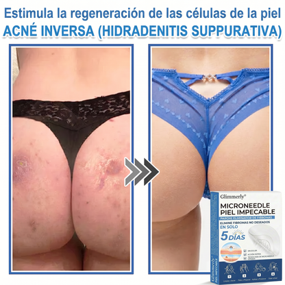 👩‍⚕️ Glimmerly® Parche 2 en 1 de microagujas e hidrocoloide | Eliminador de lunares en relieve, acné, verrugas planas y acrocordones | Mejora arrugas, cicatrices e imperfecciones | Parches invisibles para granos (rostro y cuerpo) | 144 unidades