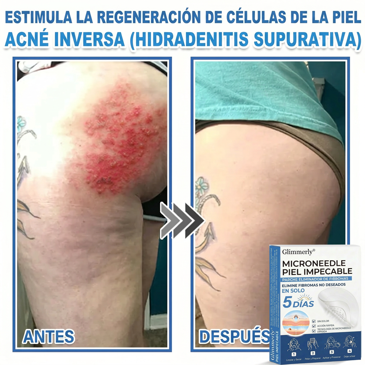 👩‍⚕️ Glimmerly® Parche 2 en 1 de microagujas e hidrocoloide | Eliminador de lunares en relieve, acné, verrugas planas y acrocordones | Mejora arrugas, cicatrices e imperfecciones | Parches invisibles para granos (rostro y cuerpo) | 144 unidades