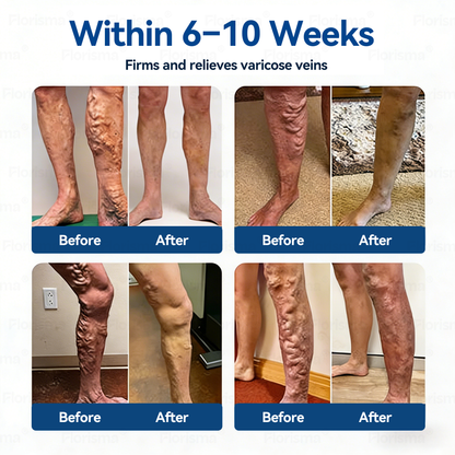 Un parche al día. Alivio visible de las venas en solo 7 días 👨‍⚕️ 𝑭𝑳𝑶𝑹𝑰𝑺𝑴𝑨® 𝐃𝐢𝐨𝐬𝐦𝐢𝐧𝐚 𝐲 𝐇𝐞𝐬𝐩𝐞𝐫𝐢𝐝𝐢𝐧𝐚: 𝐏𝐚𝐫𝐜𝐡𝐞 𝐝𝐞 𝐌𝐢𝐜𝐫𝐨𝐧𝐞𝐞𝐝𝐥𝐞𝐬 𝐜𝐨𝐧 𝐅ó𝐫𝐦𝐮𝐥𝐚 𝐝𝐞 𝐆𝐫𝐚𝐝𝐨 𝐂𝐥í𝐧𝐢𝐜𝐨🔔