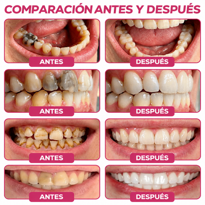 🌿🍧Rolimey® DenPerm – Gel natural de relleno y reparación del esmalte dental para la restauración de caries