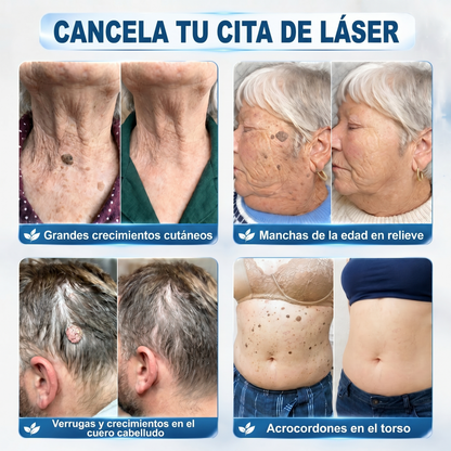 𝐏𝐢𝐜𝐝𝐨® 𝐁𝐨𝐫𝐫𝐚𝐝𝐨𝐫 𝐝𝐞 𝐕𝐞𝐫𝐫𝐮𝐠𝐚𝐬 𝐲 𝐌𝐚𝐧𝐜𝐡𝐚𝐬 𝐝𝐞 𝟕 𝐃í𝐚𝐬(Aplicador roll-on: sin dolor ni cicatrices)💪