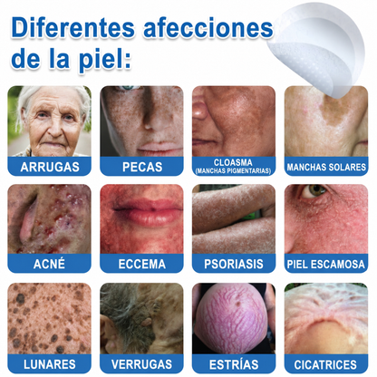 👩‍⚕️ Glimmerly® Parche 2 en 1 de microagujas e hidrocoloide | Eliminador de lunares en relieve, acné, verrugas planas y acrocordones | Mejora arrugas, cicatrices e imperfecciones | Parches invisibles para granos (rostro y cuerpo) | 144 unidades