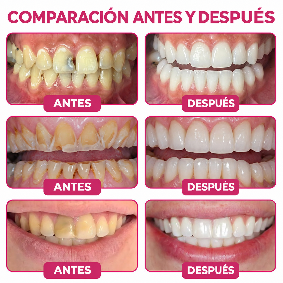 🌿🍧Rolimey® DenPerm – Gel natural de relleno y reparación del esmalte dental para la restauración de caries