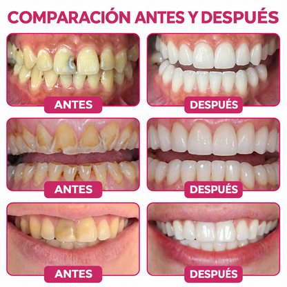 🌿🍧Rolimey® DenPerm – Gel natural de relleno y reparación del esmalte dental para la restauración de caries