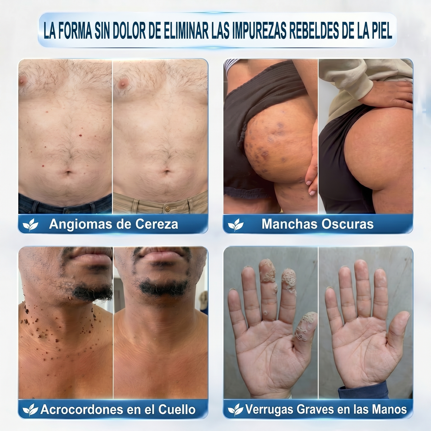 𝐏𝐢𝐜𝐝𝐨® 𝐁𝐨𝐫𝐫𝐚𝐝𝐨𝐫 𝐝𝐞 𝐕𝐞𝐫𝐫𝐮𝐠𝐚𝐬 𝐲 𝐌𝐚𝐧𝐜𝐡𝐚𝐬 𝐝𝐞 𝟕 𝐃í𝐚𝐬(Aplicador roll-on: sin dolor ni cicatrices)💪