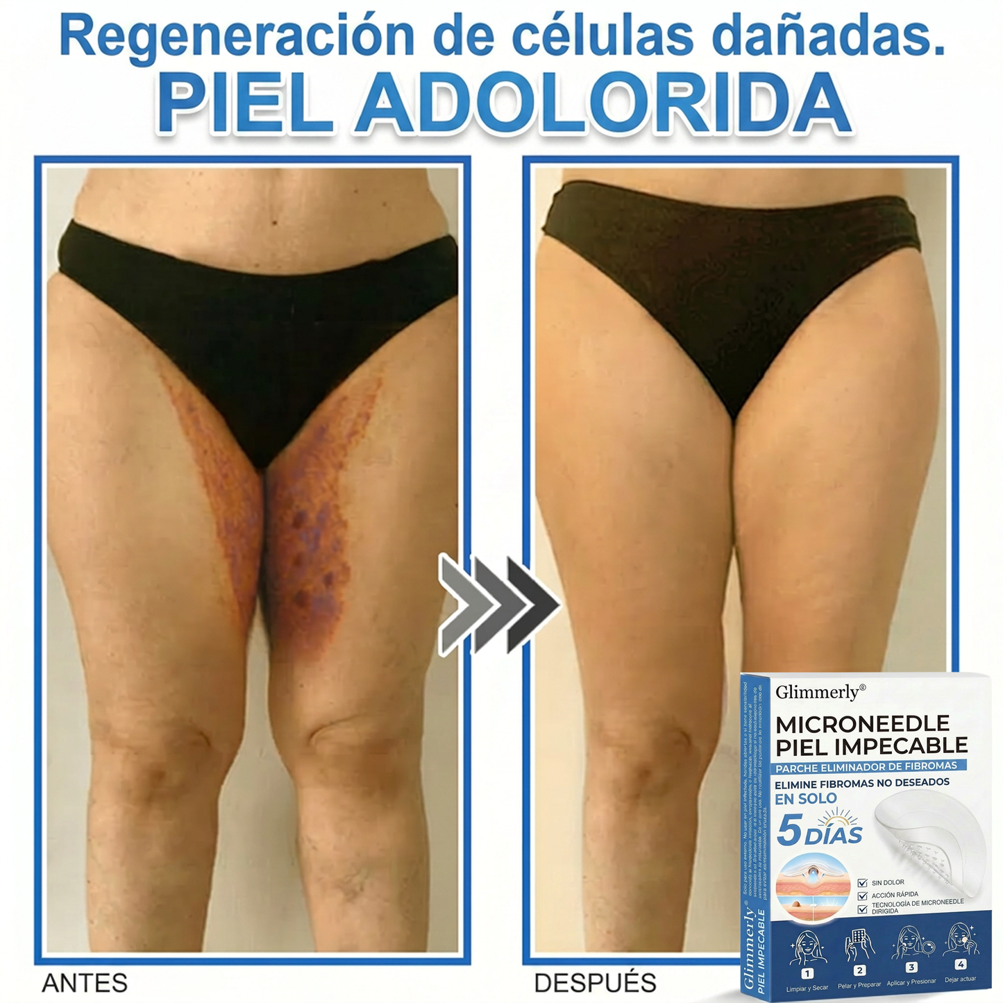 👩‍⚕️ Glimmerly® Parche 2 en 1 de microagujas e hidrocoloide | Eliminador de lunares en relieve, acné, verrugas planas y acrocordones | Mejora arrugas, cicatrices e imperfecciones | Parches invisibles para granos (rostro y cuerpo) | 144 unidades