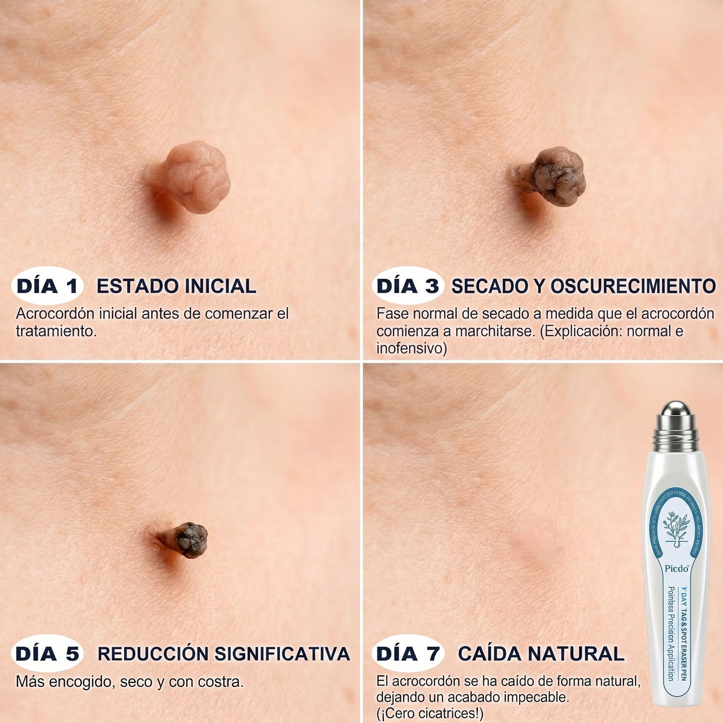 𝐏𝐢𝐜𝐝𝐨® 𝐁𝐨𝐫𝐫𝐚𝐝𝐨𝐫 𝐝𝐞 𝐕𝐞𝐫𝐫𝐮𝐠𝐚𝐬 𝐲 𝐌𝐚𝐧𝐜𝐡𝐚𝐬 𝐝𝐞 𝟕 𝐃í𝐚𝐬(Aplicador roll-on: sin dolor ni cicatrices)💪