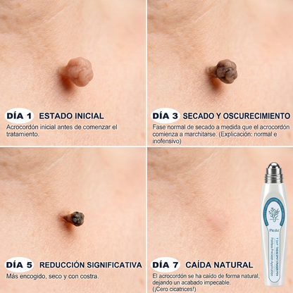 𝐏𝐢𝐜𝐝𝐨® 𝐁𝐨𝐫𝐫𝐚𝐝𝐨𝐫 𝐝𝐞 𝐕𝐞𝐫𝐫𝐮𝐠𝐚𝐬 𝐲 𝐌𝐚𝐧𝐜𝐡𝐚𝐬 𝐝𝐞 𝟕 𝐃í𝐚𝐬(Aplicador roll-on: sin dolor ni cicatrices)💪