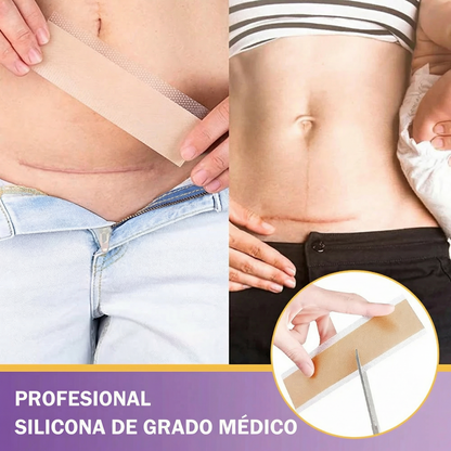 ✅Tienda oficial | BBOJI® ácido hialurónico cinta de reparación de nano micromujas 🏥(tratamiento de cicatrices antiguas y recientes, reducción de cicatrices quirúrgicas, estrías, queloides, acné, quemaduras, verrugas, dermatomas y varices)