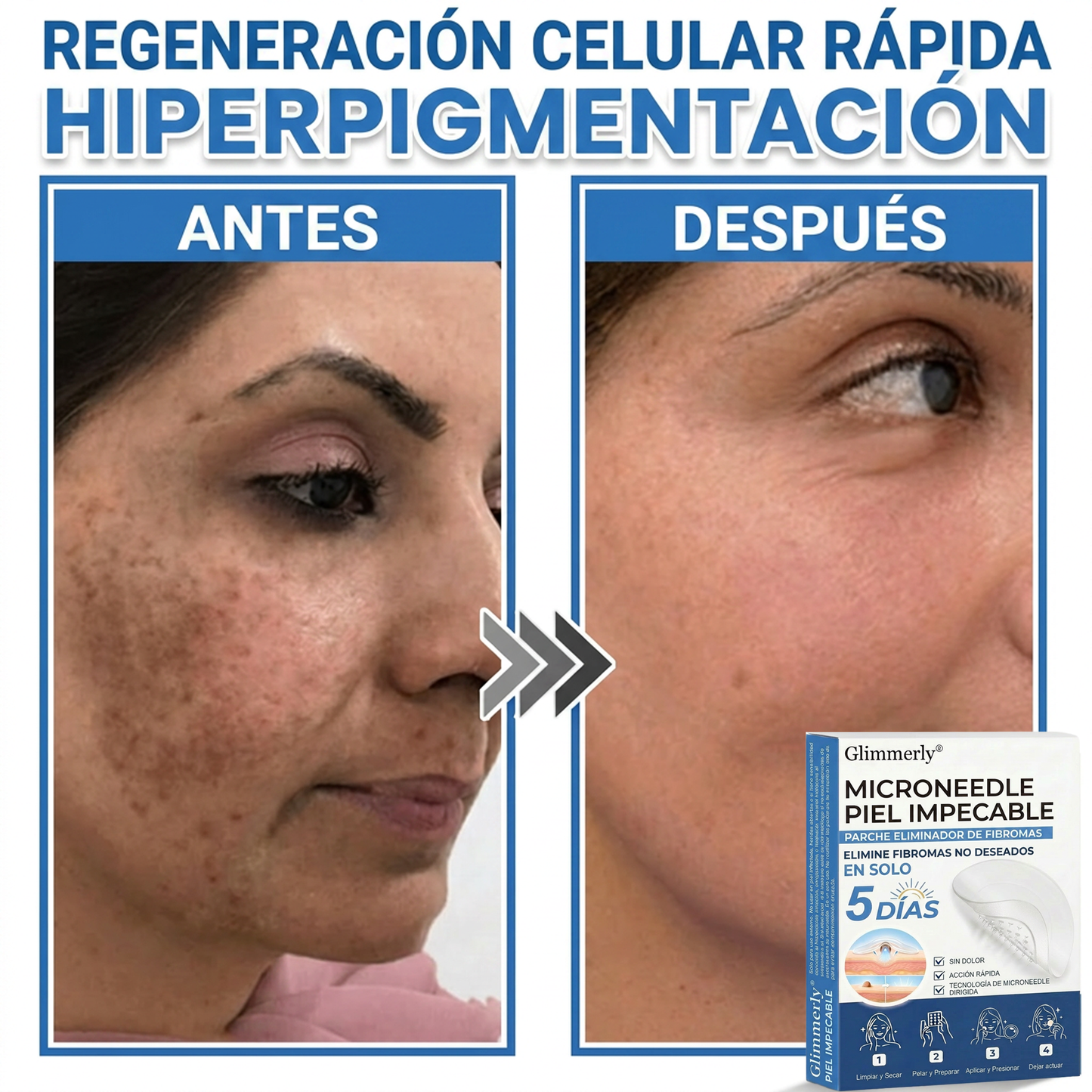 👩‍⚕️ Glimmerly® Parche 2 en 1 de microagujas e hidrocoloide | Eliminador de lunares en relieve, acné, verrugas planas y acrocordones | Mejora arrugas, cicatrices e imperfecciones | Parches invisibles para granos (rostro y cuerpo) | 144 unidades